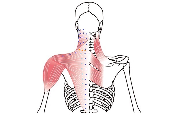 刺鍼