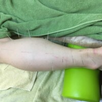 アキレス腱炎の鍼灸