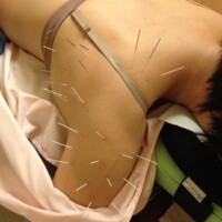 肩の痛みの鍼灸