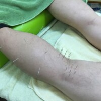 膝痛の鍼治療