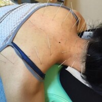 首肩こりの鍼灸治療