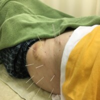 左足痛、臀部痛の鍼治療