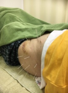 左足痛、臀部痛の鍼治療