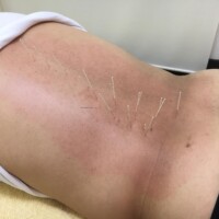 ぎっくり腰の鍼治療