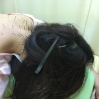 首肩こりの鍼灸