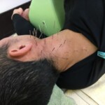 耳鳴りの鍼治療