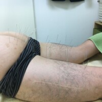 両臀部痛の鍼治療