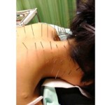 頭痛の鍼治療