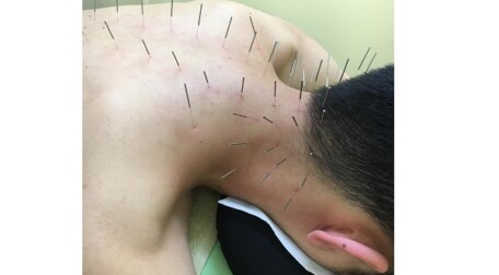 肩こりの鍼治療