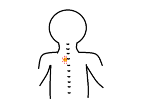 寝違えの刺鍼位置